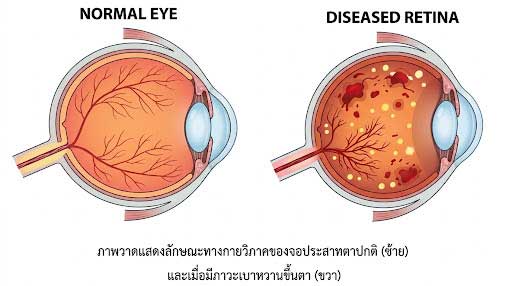 ภาวะเบาหวานขึ้นตา