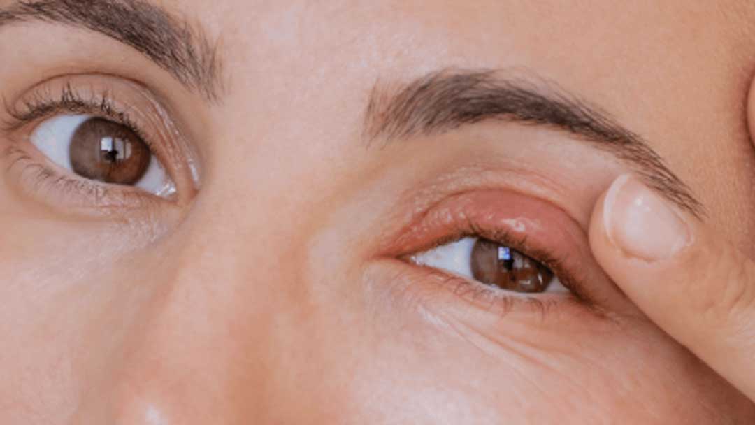 ต่อมไขมันเปลือกตาอุดตัน คืออะไร ดูแลรักษาอย่างอย่างไร?