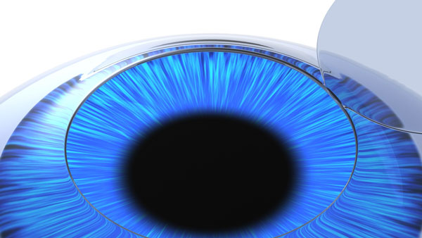 SBK LASIK คืออะไร?